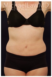 Tummy Tuck After Photo by Michael Law, MD; Raleigh, NC - Case 33690