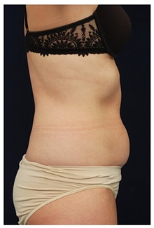 Tummy Tuck Before Photo by Michael Law, MD; Raleigh, NC - Case 33690