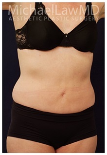 Tummy Tuck After Photo by Michael Law, MD; Raleigh, NC - Case 33690