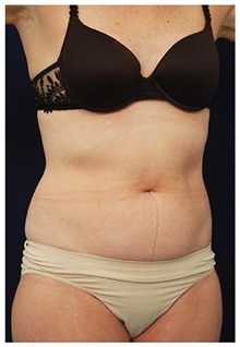 Tummy Tuck Before Photo by Michael Law, MD; Raleigh, NC - Case 33690