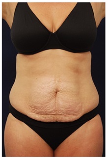 Tummy Tuck Before Photo by Michael Law, MD; Raleigh, NC - Case 33692