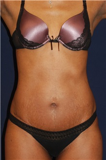 Tummy Tuck After Photo by Michael Law, MD; Raleigh, NC - Case 33693