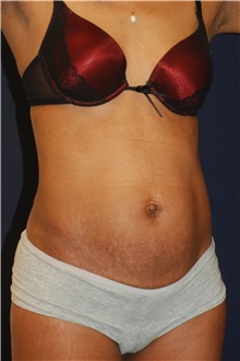 Tummy Tuck Before Photo by Michael Law, MD; Raleigh, NC - Case 33693