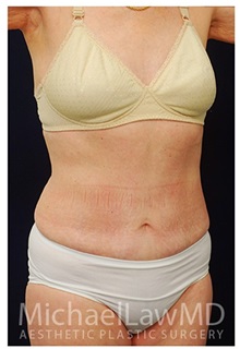 Tummy Tuck After Photo by Michael Law, MD; Raleigh, NC - Case 33694