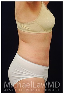 Tummy Tuck After Photo by Michael Law, MD; Raleigh, NC - Case 33694