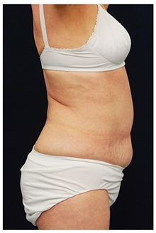 Tummy Tuck Before Photo by Michael Law, MD; Raleigh, NC - Case 33694