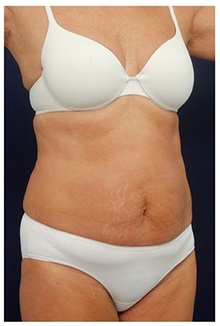 Tummy Tuck Before Photo by Michael Law, MD; Raleigh, NC - Case 33695