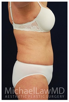 Tummy Tuck After Photo by Michael Law, MD; Raleigh, NC - Case 33695