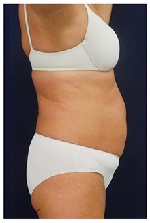Tummy Tuck Before Photo by Michael Law, MD; Raleigh, NC - Case 33695