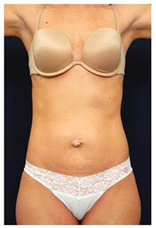 Tummy Tuck Before Photo by Michael Law, MD; Raleigh, NC - Case 33696
