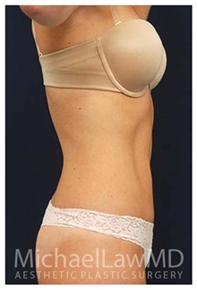 Tummy Tuck After Photo by Michael Law, MD; Raleigh, NC - Case 33696