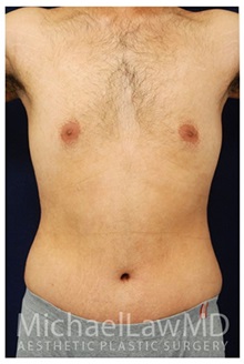 Tummy Tuck After Photo by Michael Law, MD; Raleigh, NC - Case 33697