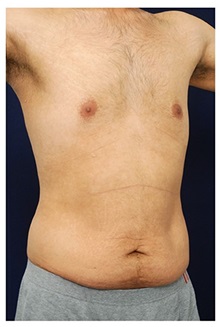 Tummy Tuck Before Photo by Michael Law, MD; Raleigh, NC - Case 33697
