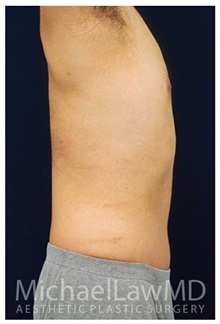 Tummy Tuck After Photo by Michael Law, MD; Raleigh, NC - Case 33697