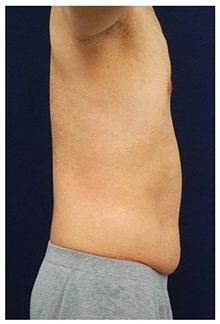 Tummy Tuck Before Photo by Michael Law, MD; Raleigh, NC - Case 33697