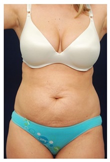 Tummy Tuck Before Photo by Michael Law, MD; Raleigh, NC - Case 33698