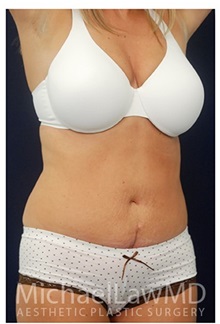 Tummy Tuck After Photo by Michael Law, MD; Raleigh, NC - Case 33698