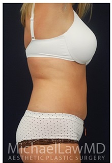 Tummy Tuck After Photo by Michael Law, MD; Raleigh, NC - Case 33698