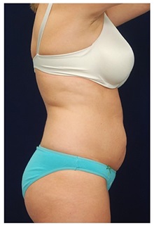 Tummy Tuck Before Photo by Michael Law, MD; Raleigh, NC - Case 33698