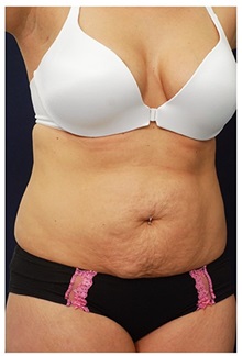 Tummy Tuck Before Photo by Michael Law, MD; Raleigh, NC - Case 33699
