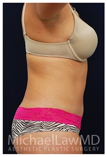 Tummy Tuck After Photo by Michael Law, MD; Raleigh, NC - Case 33699
