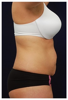 Tummy Tuck Before Photo by Michael Law, MD; Raleigh, NC - Case 33699