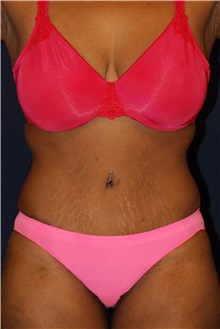 Tummy Tuck After Photo by Michael Law, MD; Raleigh, NC - Case 33704