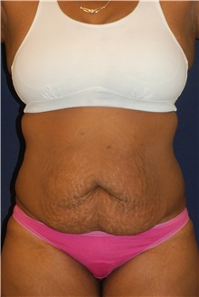 Tummy Tuck Before Photo by Michael Law, MD; Raleigh, NC - Case 33704