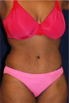 Tummy Tuck After Photo by Michael Law, MD; Raleigh, NC - Case 33704