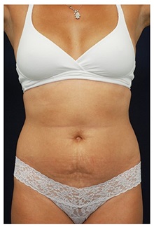 Tummy Tuck Before Photo by Michael Law, MD; Raleigh, NC - Case 33705