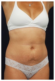 Tummy Tuck Before Photo by Michael Law, MD; Raleigh, NC - Case 33705