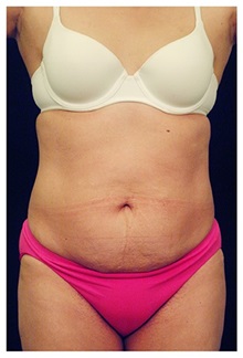 Tummy Tuck Before Photo by Michael Law, MD; Raleigh, NC - Case 33707
