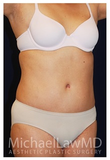 Tummy Tuck After Photo by Michael Law, MD; Raleigh, NC - Case 33707