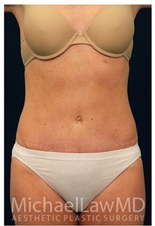 Tummy Tuck After Photo by Michael Law, MD; Raleigh, NC - Case 33708