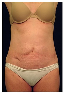 Tummy Tuck Before Photo by Michael Law, MD; Raleigh, NC - Case 33708