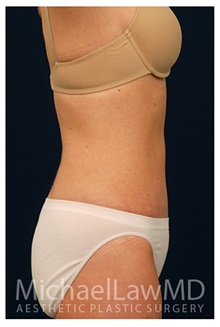 Tummy Tuck After Photo by Michael Law, MD; Raleigh, NC - Case 33708