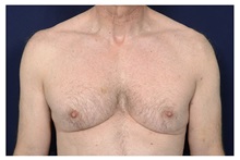 Male Breast Reduction Before Photo by Michael Law, MD; Raleigh, NC - Case 33712