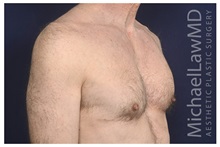 Male Breast Reduction After Photo by Michael Law, MD; Raleigh, NC - Case 33712