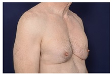 Male Breast Reduction Before Photo by Michael Law, MD; Raleigh, NC - Case 33712