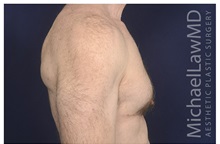 Male Breast Reduction After Photo by Michael Law, MD; Raleigh, NC - Case 33712