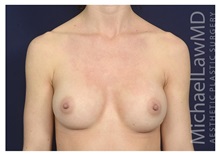 Breast Augmentation After Photo by Michael Law, MD; Raleigh, NC - Case 33720
