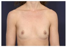Breast Augmentation Before Photo by Michael Law, MD; Raleigh, NC - Case 33720