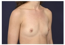 Breast Augmentation Before Photo by Michael Law, MD; Raleigh, NC - Case 33720