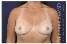 Breast Reduction After Photo by Michael Law, MD; Raleigh, NC - Case 33722