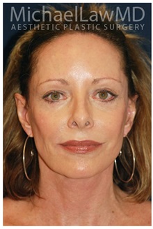 Facelift After Photo by Michael Law, MD; Raleigh, NC - Case 33738