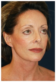 Facelift Before Photo by Michael Law, MD; Raleigh, NC - Case 33738