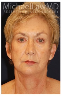 Facelift After Photo by Michael Law, MD; Raleigh, NC - Case 33739