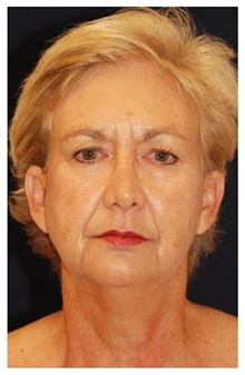 Facelift Before Photo by Michael Law, MD; Raleigh, NC - Case 33739