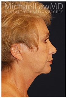 Facelift After Photo by Michael Law, MD; Raleigh, NC - Case 33739