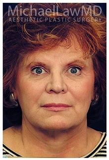 Facelift After Photo by Michael Law, MD; Raleigh, NC - Case 33740